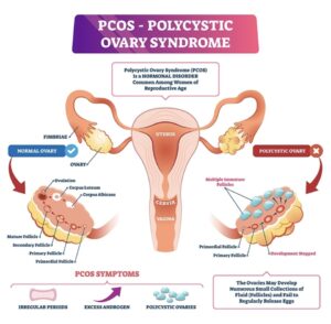 PCOS Syndromes